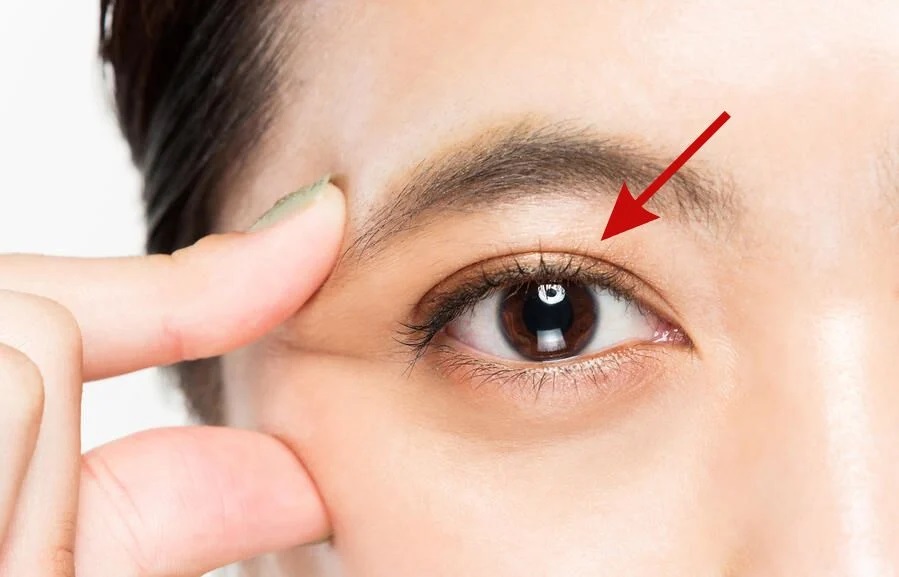 Understanding Double Eyelid Surgery: What You Need to Know